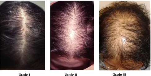 Medical Alopecia Phases | Laguna Dermatology in Laguna Hills, CA
