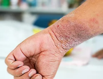 Men's Hand with Eczema | Laguna Dermatology in Laguna Hills, CA