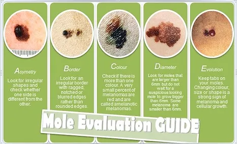 Mole Evaluation Guide Template | Medical in Laguna Hills, CA | Laguna Dermatology and Aesthetics