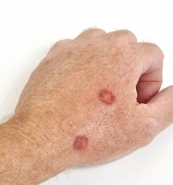 Hands with Precancerous Lesions | Laguna Dermatology in Laguna Hills, CA