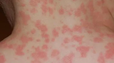 Skin Rashes | Laguna Dermatology in Laguna Hills, CA