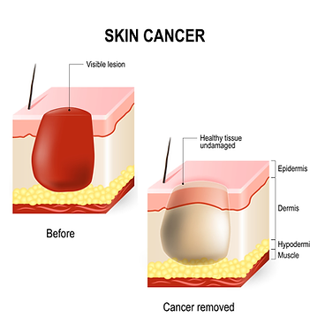 A Diagram of Skin Cancer | Laguna Dermatology in Laguna Hills, CA