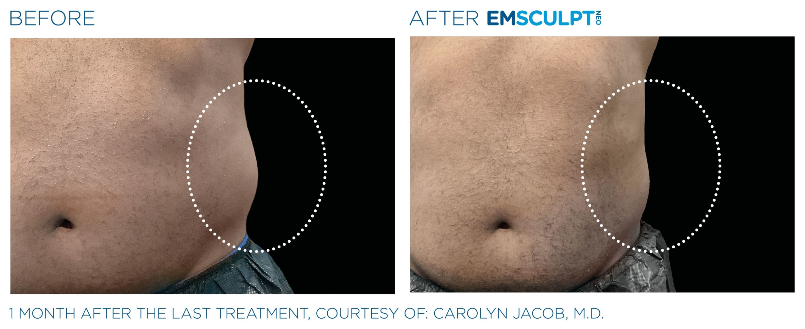 Abdomen-Before-After-Images-In-Laguna-Hills-Two-1