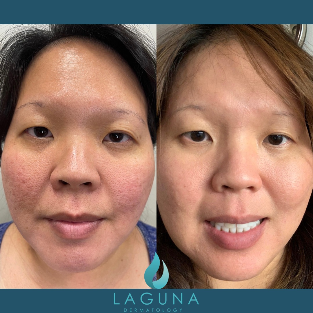 Acne-Scar-Treatment-women-front-view-Laguna-hills